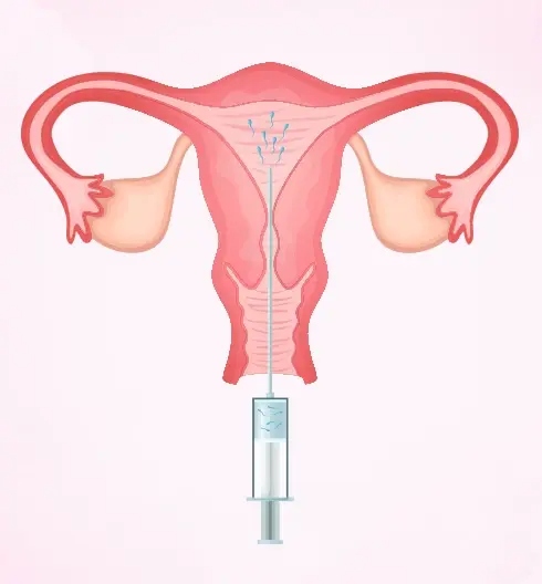 IUI near Saket, Delhi at Pravi Global IVF